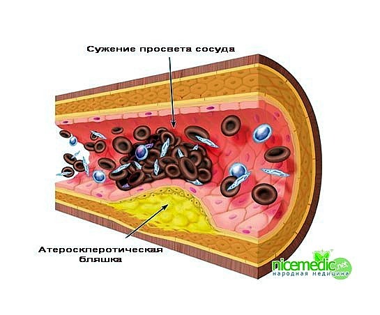 Сестринский процесс при атеросклерозе