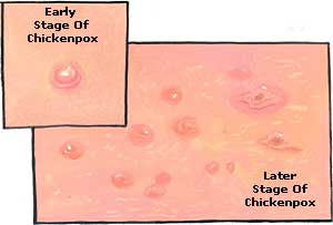 Урок английского языка на тему Chickenpox