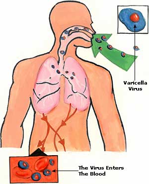 Урок английского языка на тему Chickenpox