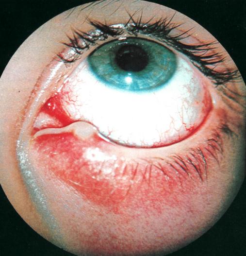 Заболевания вспомогательного аппарата глаза