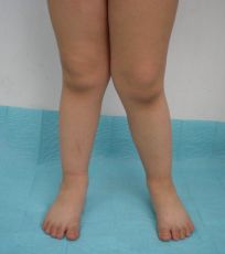 Буклет Вальгусная деформация коленных суставов