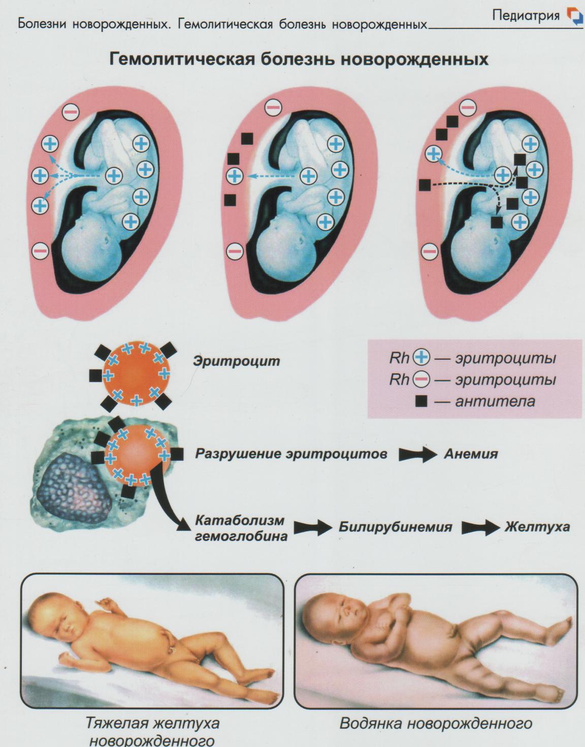 Гемолитическая болезнь новорожденных картинки