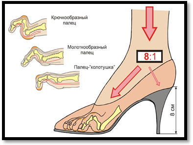 Доклад к презентации: Вред высоких каблуков с точки зрения физики.